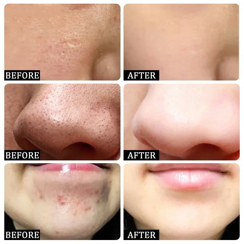 Salicylic Acid Pore Clearing C - огляд і ціна Azelaic Acid Cream