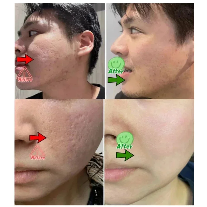 Salicylic Acid Pore Clearing C - огляд і ціна Azelaic Acid Cream