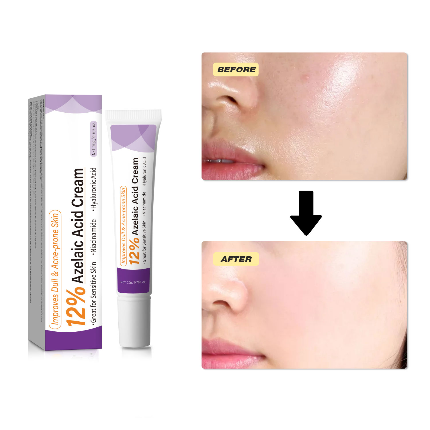 Mild Azelaic Acid Cream Improv - огляд і ціна Azelaic Acid Cream