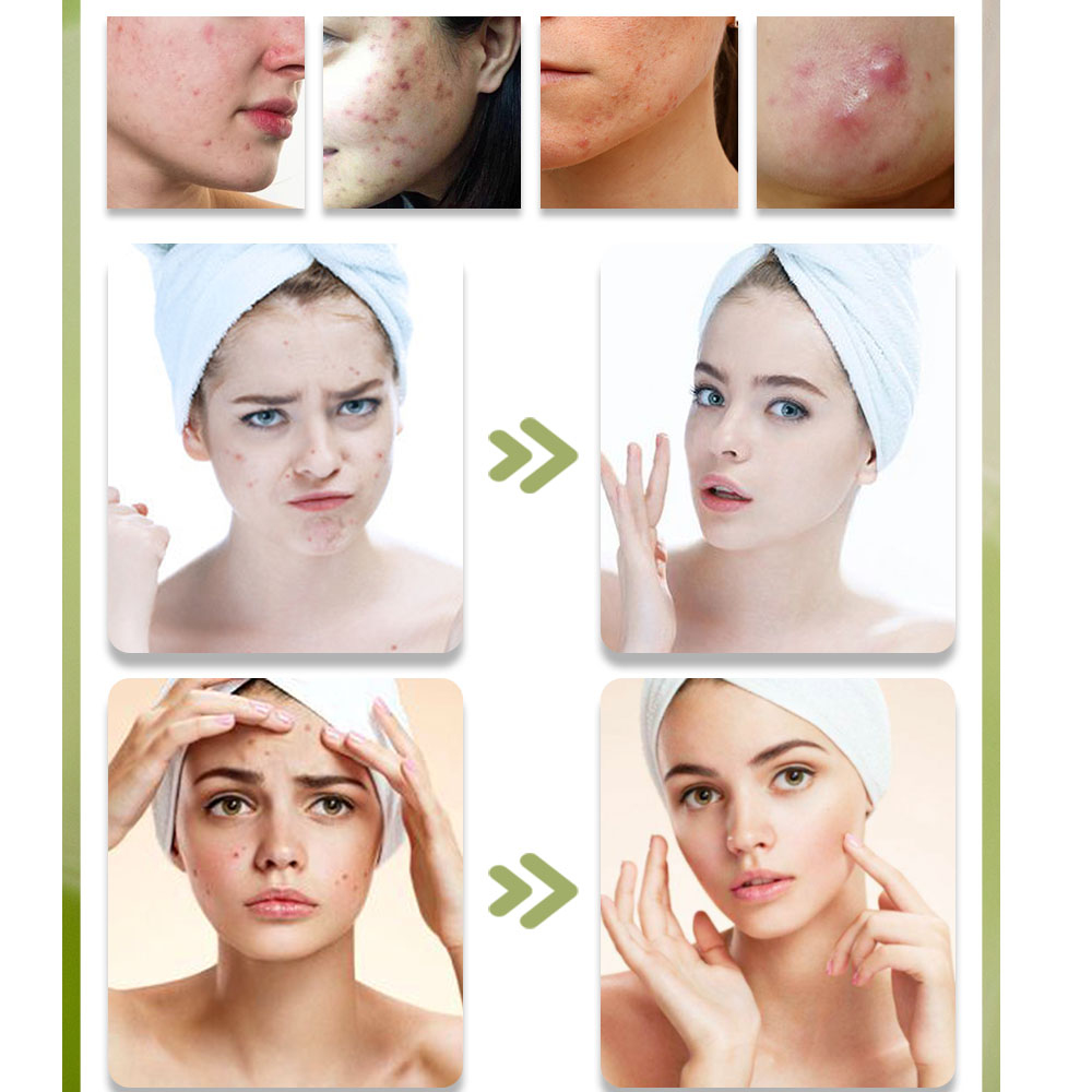 KStims Natural Acne Treatment  - огляд і ціна Tea Tree Spot Treatment